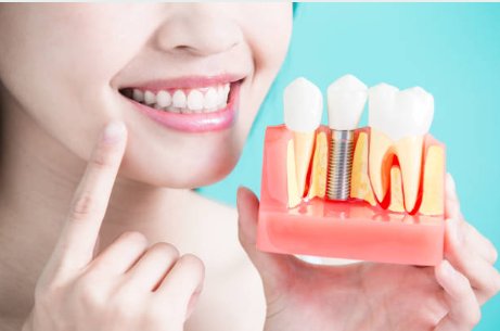 Dental Implants Las Vegas