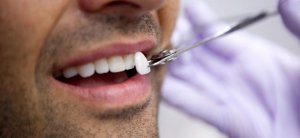 Veneers Dentist Las Vegas